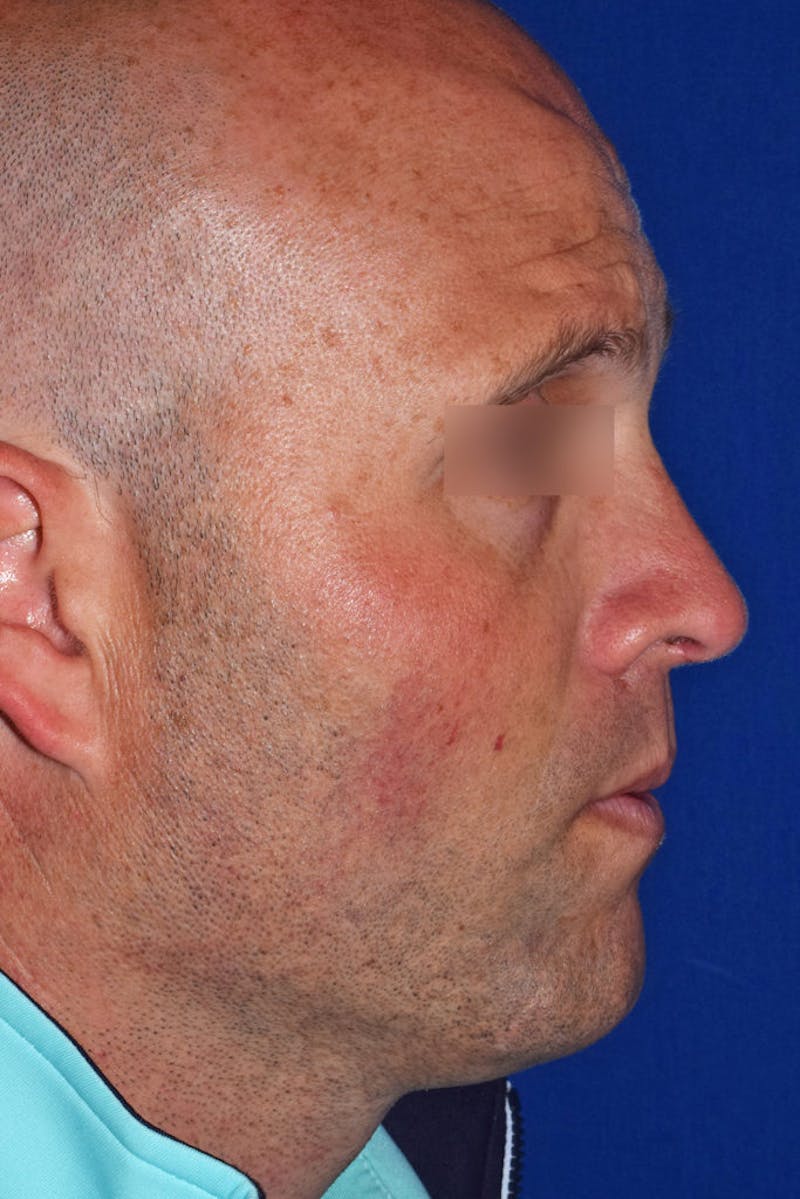 Ultrasonic Rhinoplasty Before & After Gallery - Patient 414482 - Image 1