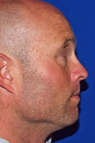 Ultrasonic Rhinoplasty Before & After Gallery - Patient 414482 - Image 2