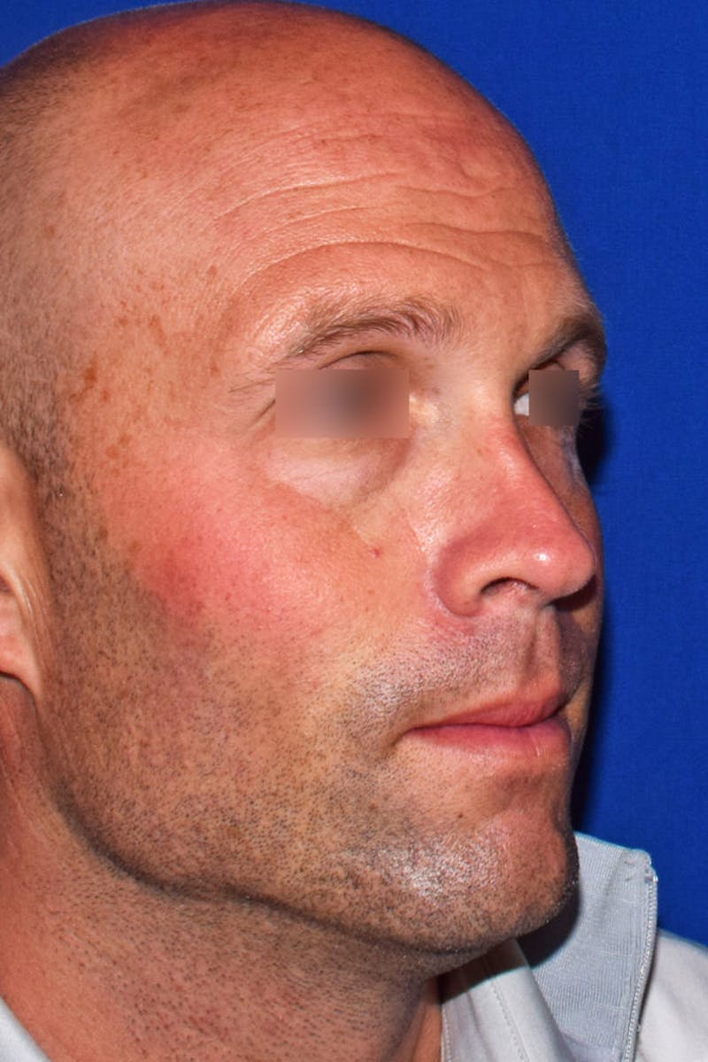Ultrasonic Rhinoplasty Before & After Gallery - Patient 414482 - Image 3