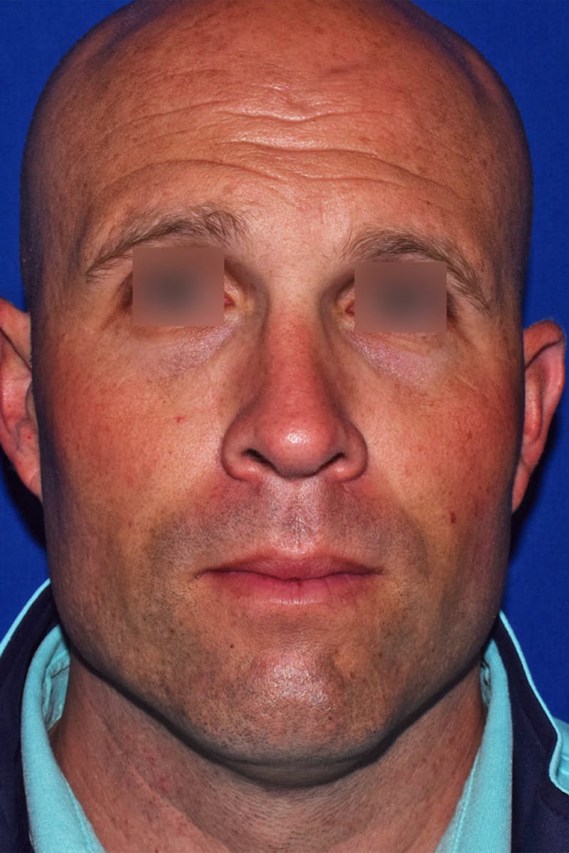 Ultrasonic Rhinoplasty Before & After Gallery - Patient 414482 - Image 6