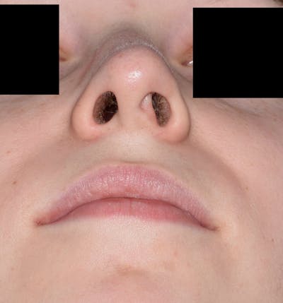 Ultrasonic Rhinoplasty Before & After Gallery - Patient 278764 - Image 1