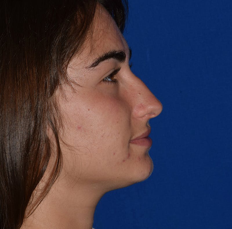 Ultrasonic Rhinoplasty Before & After Gallery - Patient 426327 - Image 1