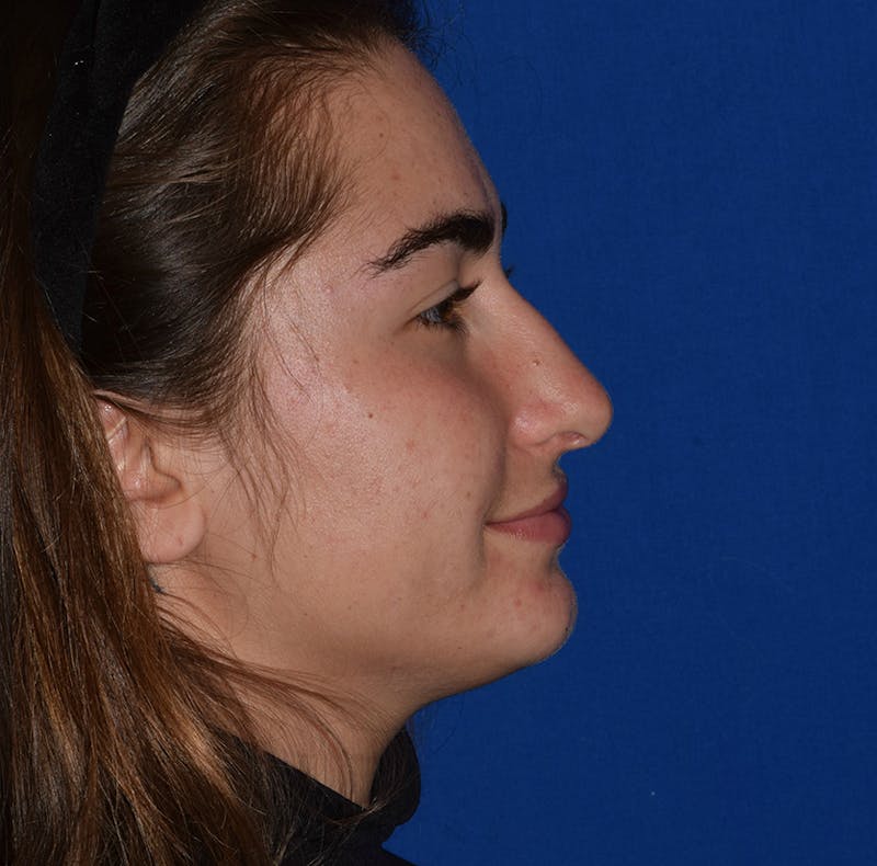 Ultrasonic Rhinoplasty Before & After Gallery - Patient 426327 - Image 2