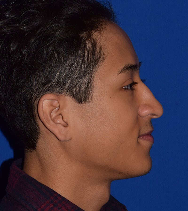 Ultrasonic Rhinoplasty Before & After Gallery - Patient 564603 - Image 1