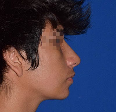 Ultrasonic Rhinoplasty Before & After Gallery - Patient 887827 - Image 2