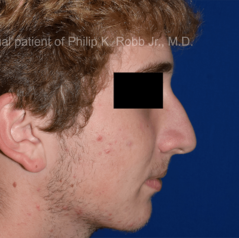 Ultrasonic Rhinoplasty Before & After Gallery - Patient 130849 - Image 1