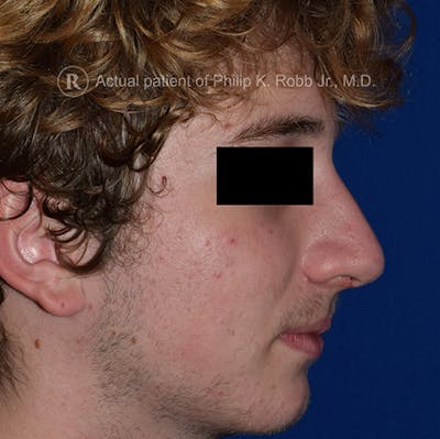 Ultrasonic Rhinoplasty Before & After Gallery - Patient 130849 - Image 2