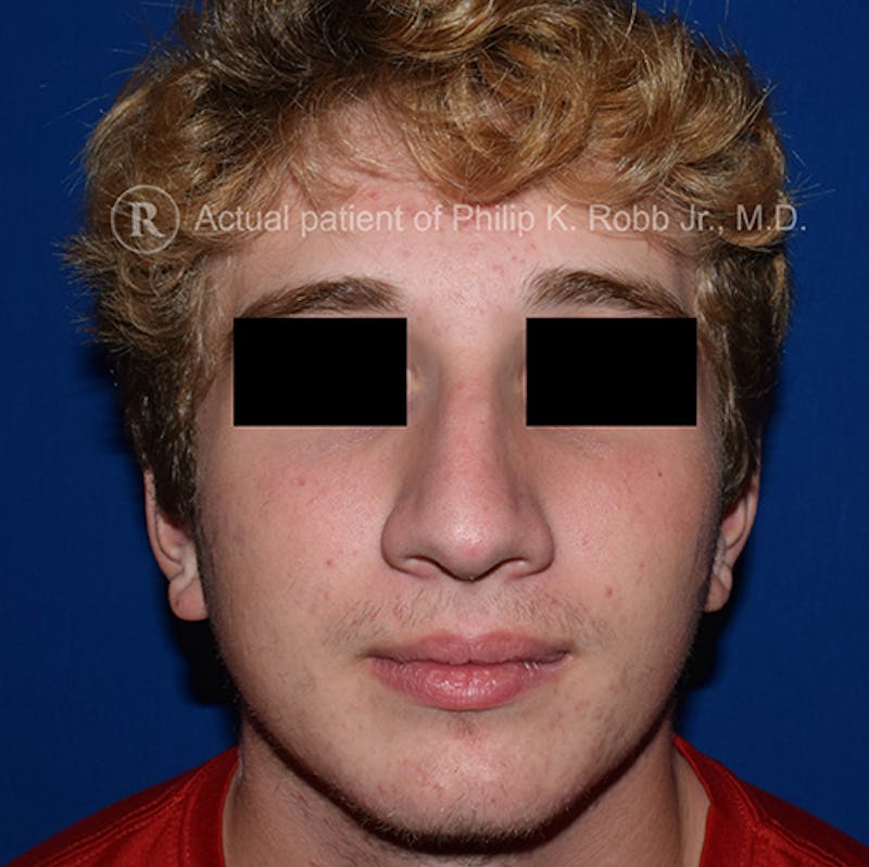 Ultrasonic Rhinoplasty Before & After Gallery - Patient 130849 - Image 5