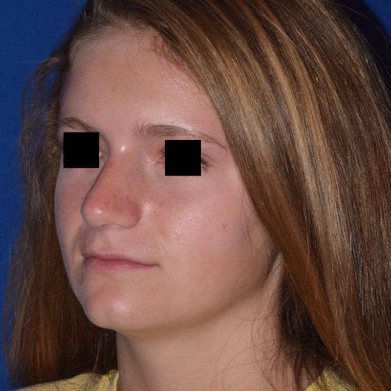 Ultrasonic Rhinoplasty Before & After Gallery - Patient 374050 - Image 4