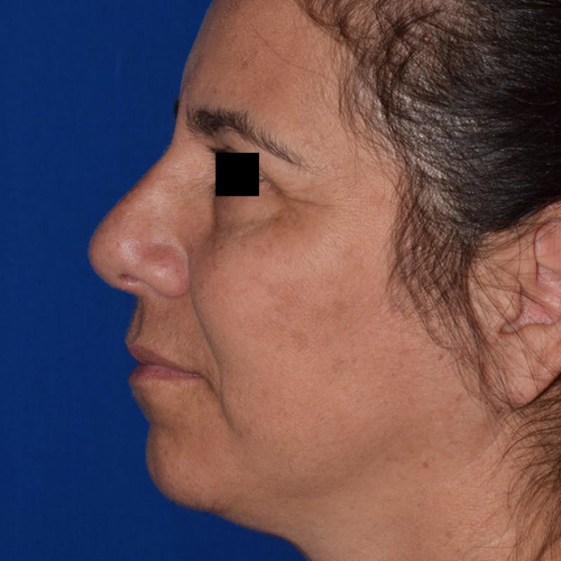 Ultrasonic Rhinoplasty Before & After Gallery - Patient 188422 - Image 2