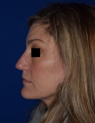 Ultrasonic Rhinoplasty Before & After Gallery - Patient 376080 - Image 1