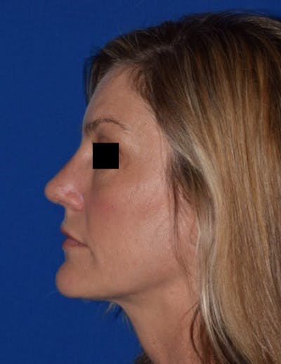 Ultrasonic Rhinoplasty Before & After Gallery - Patient 376080 - Image 2