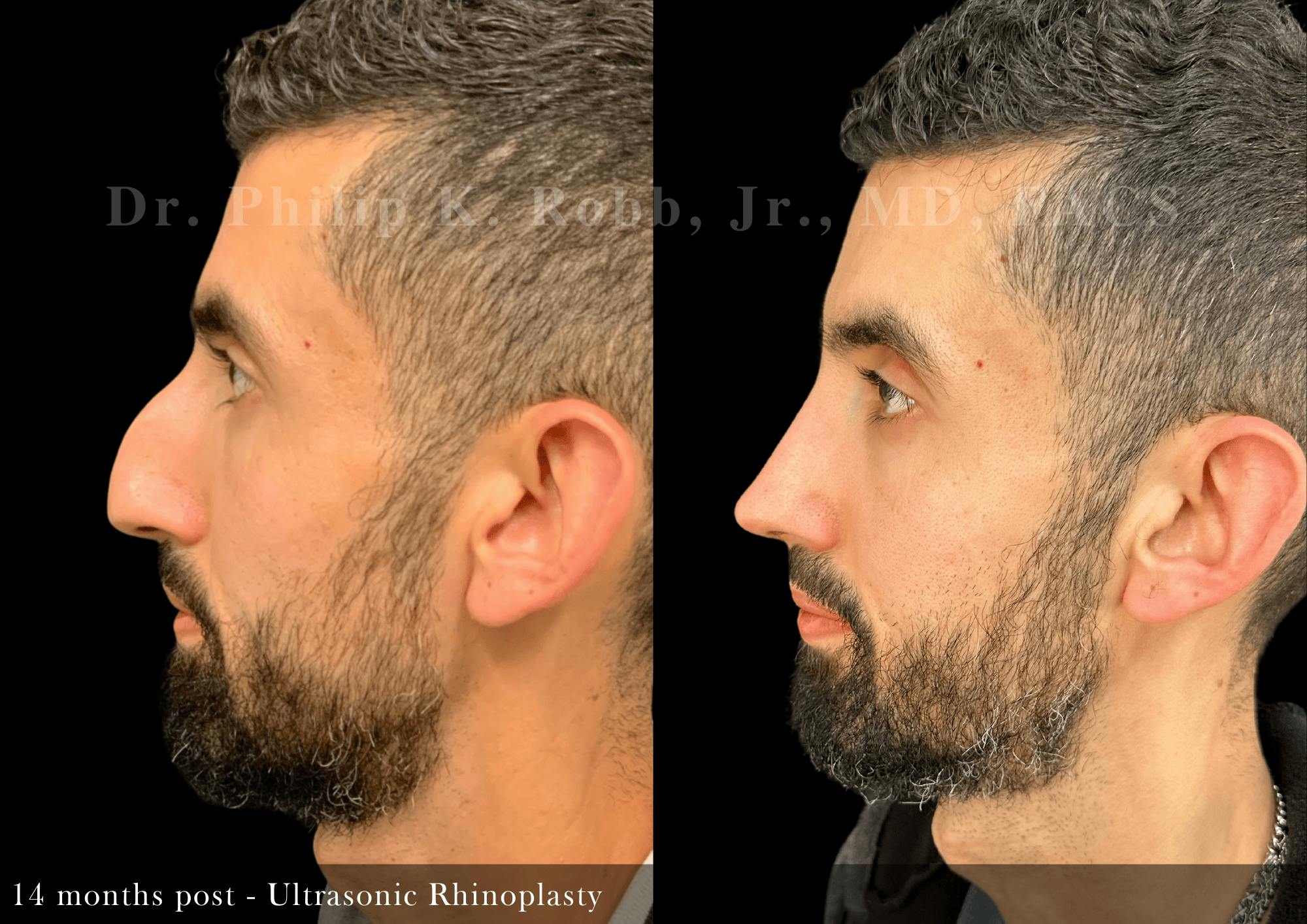 Ultrasonic Rhinoplasty Before & After Gallery - Patient 370551 - Image 5