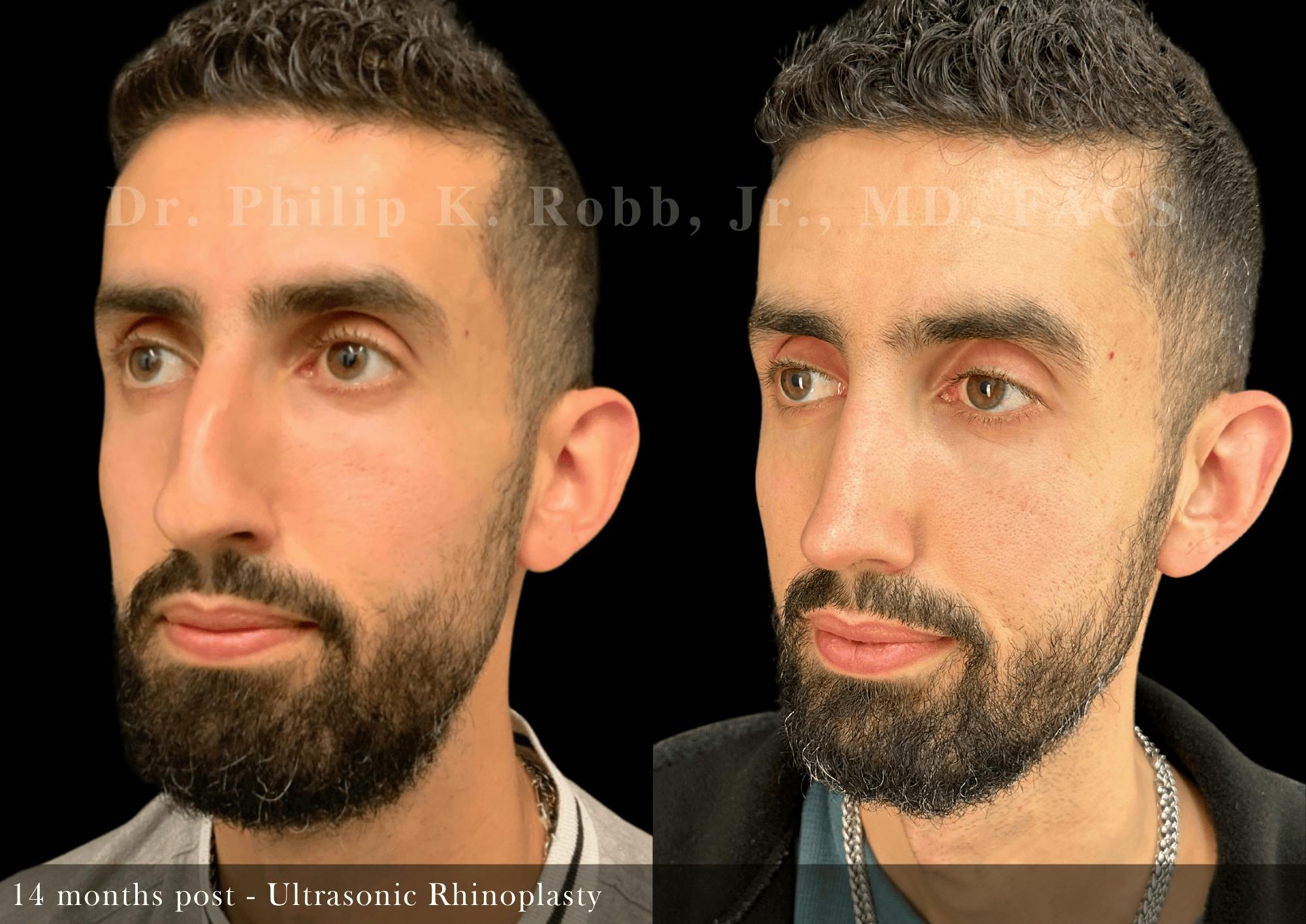 Ultrasonic Rhinoplasty Before & After Gallery - Patient 370551 - Image 4