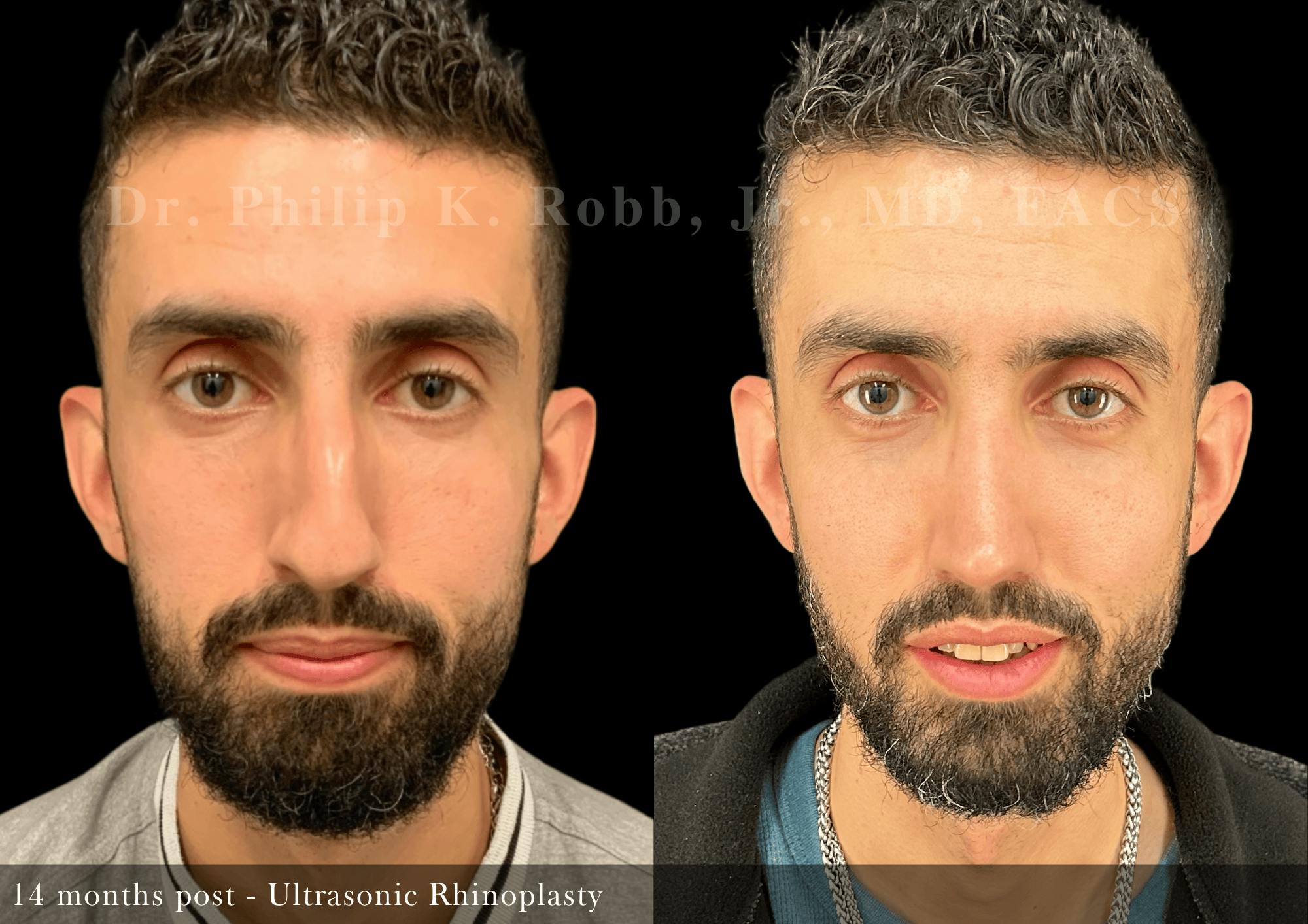 Ultrasonic Rhinoplasty Before & After Gallery - Patient 370551 - Image 3