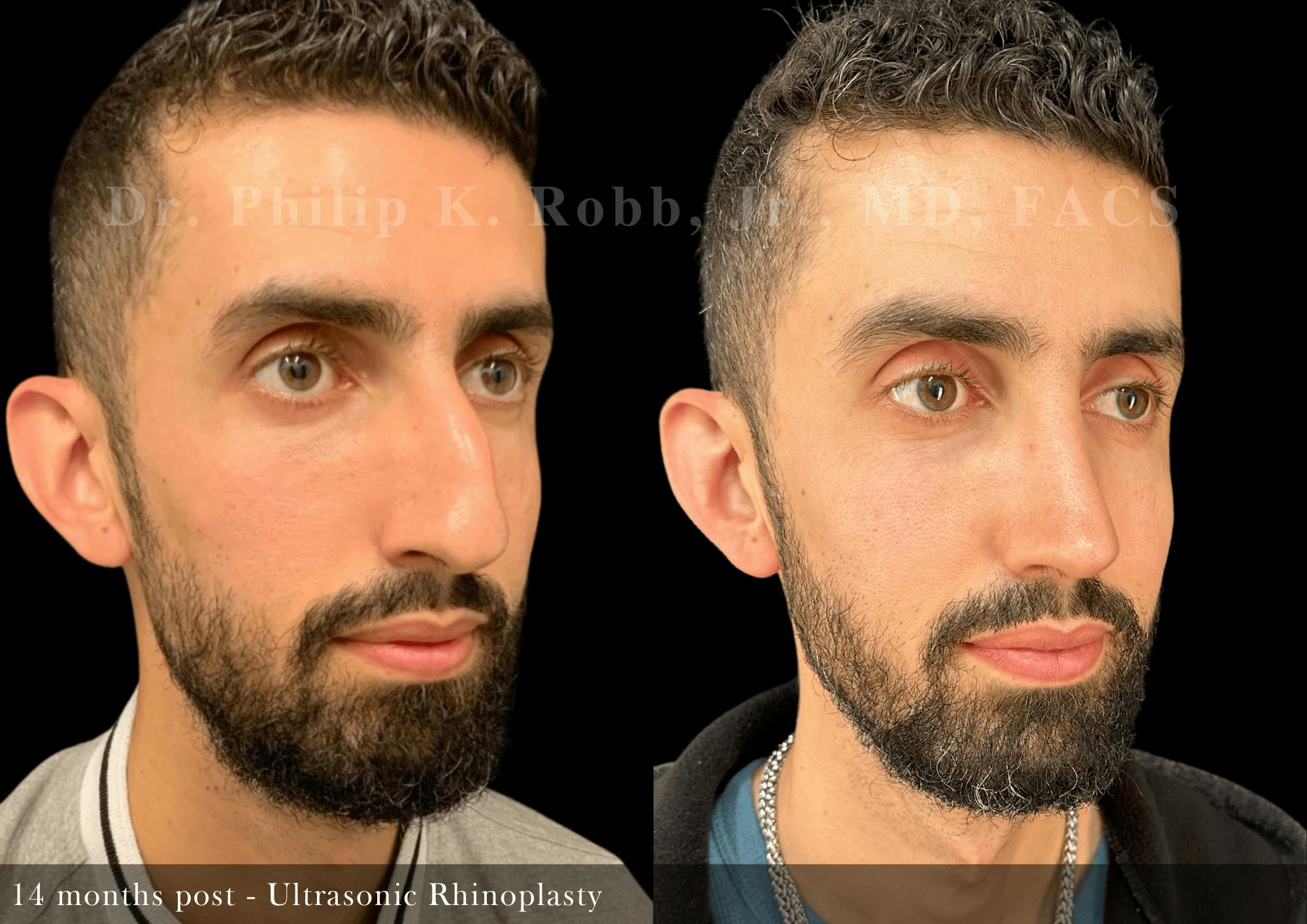 Ultrasonic Rhinoplasty Before & After Gallery - Patient 370551 - Image 2