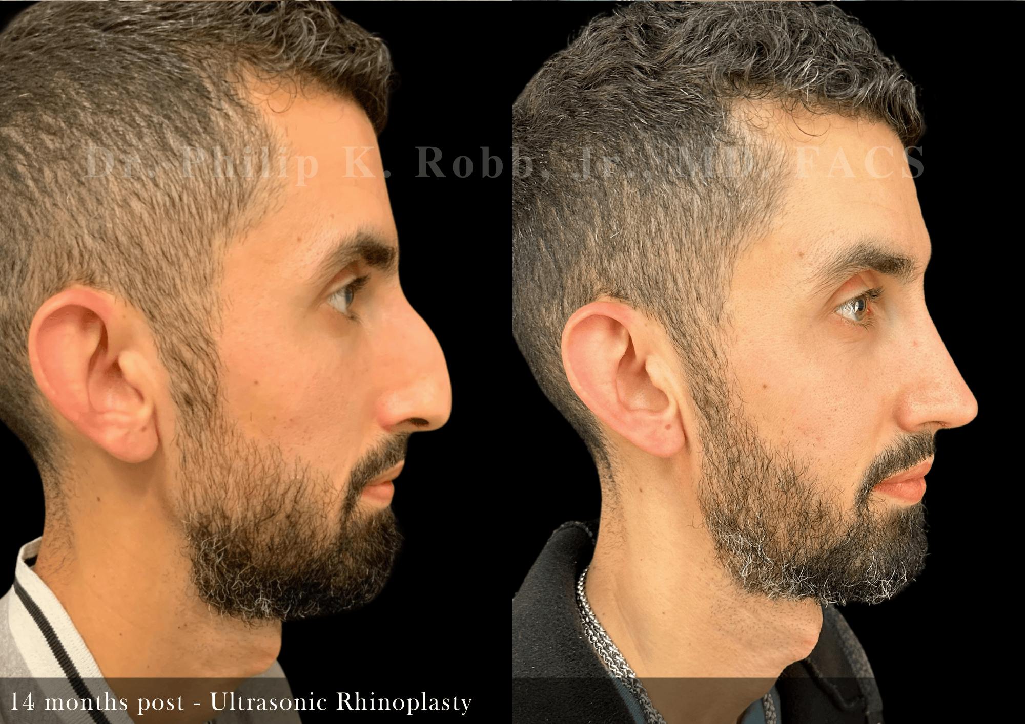 Ultrasonic Rhinoplasty Before & After Gallery - Patient 370551 - Image 1