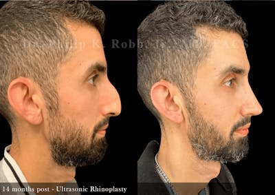 Ultrasonic Rhinoplasty Before & After Gallery - Patient 370551 - Image 1
