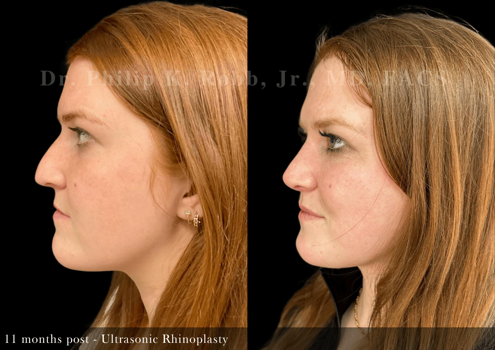 Ultrasonic Rhinoplasty Before & After Gallery - Patient 408529 - Image 5