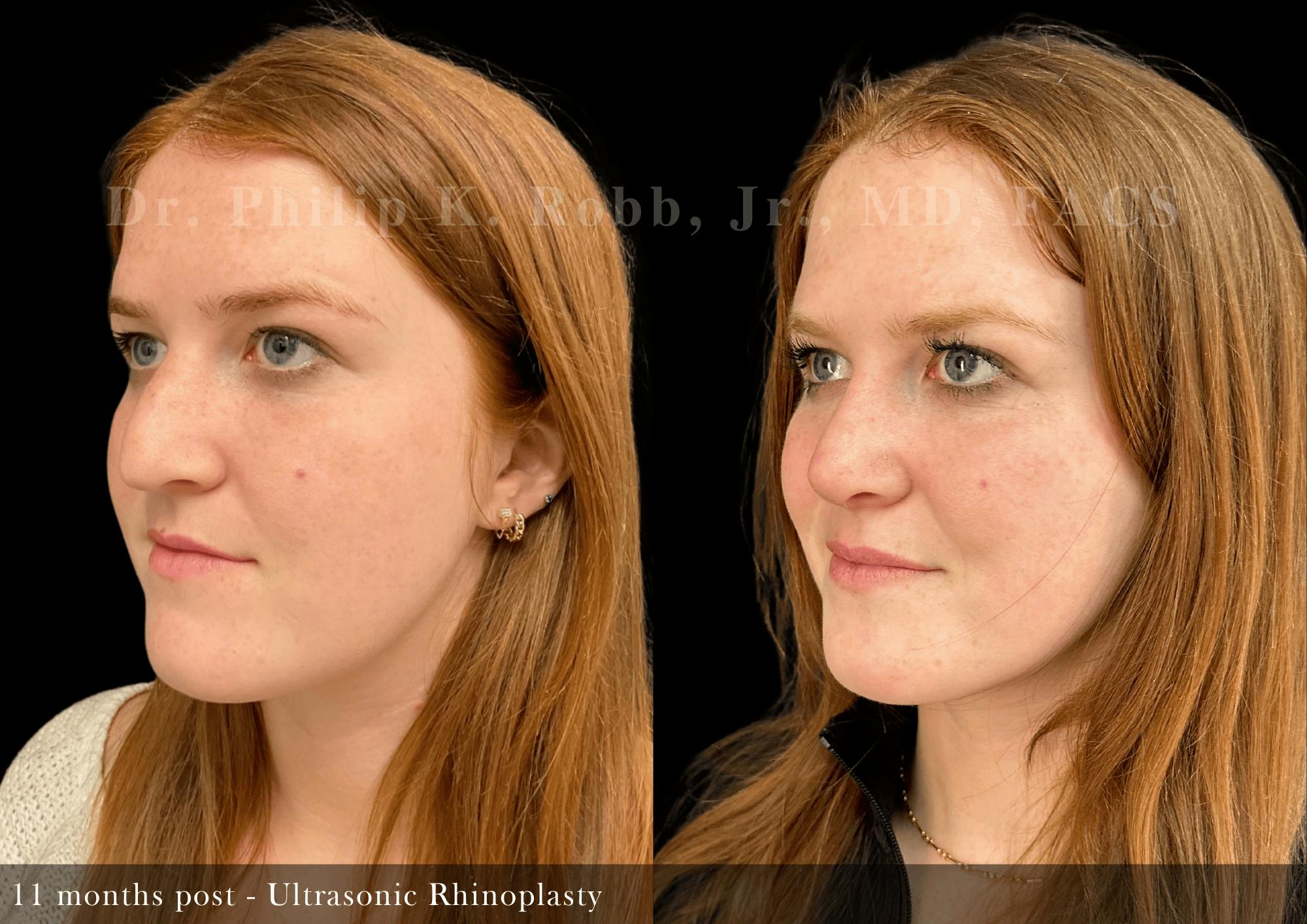 Ultrasonic Rhinoplasty Before & After Gallery - Patient 408529 - Image 4