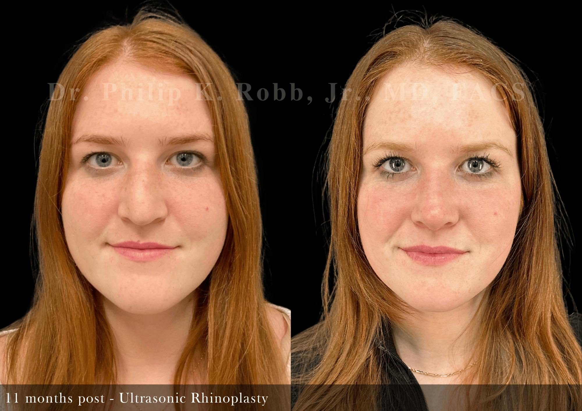 Ultrasonic Rhinoplasty Before & After Gallery - Patient 408529 - Image 3