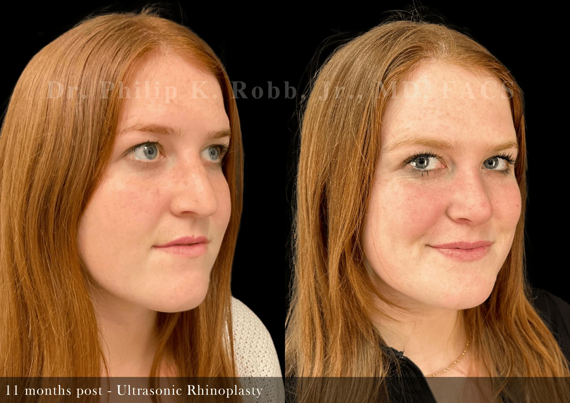 Ultrasonic Rhinoplasty Before & After Gallery - Patient 408529 - Image 2