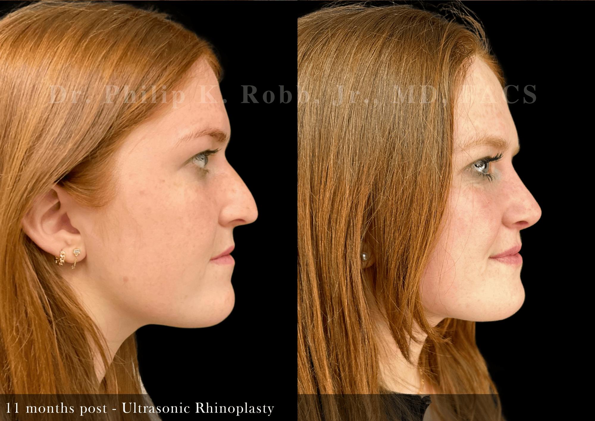 Ultrasonic Rhinoplasty Before & After Gallery - Patient 408529 - Image 1