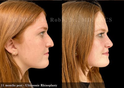 Ultrasonic Rhinoplasty Before & After Gallery - Patient 408529 - Image 1