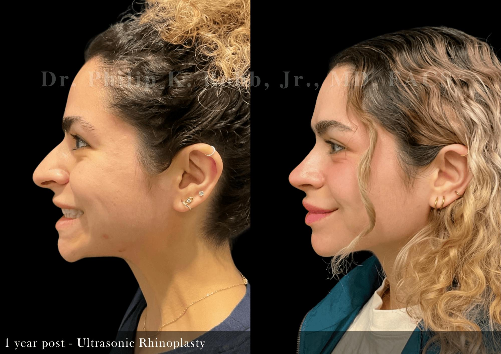 Ultrasonic Rhinoplasty Before & After Gallery - Patient 400435 - Image 5