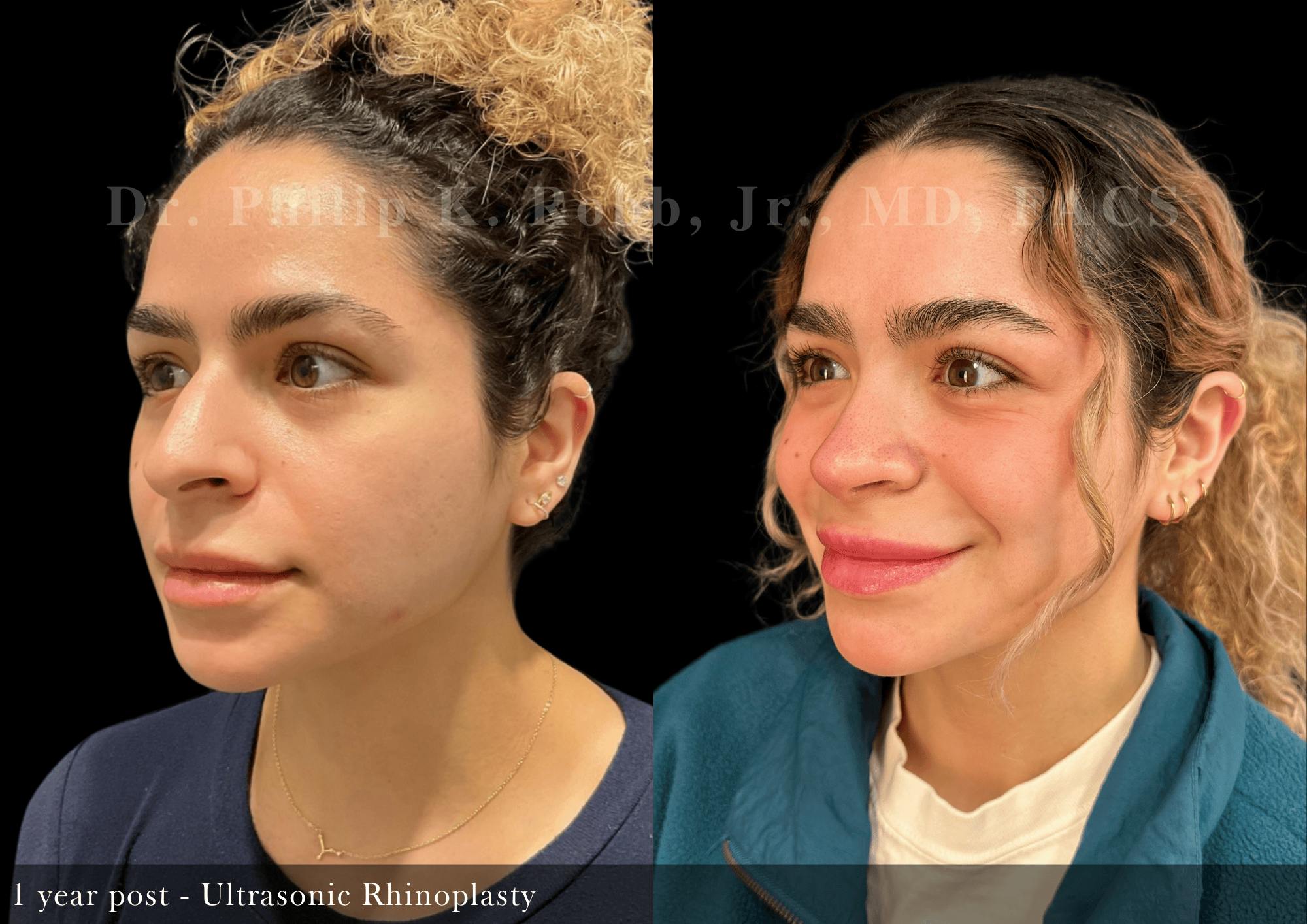 Ultrasonic Rhinoplasty Before & After Gallery - Patient 400435 - Image 4