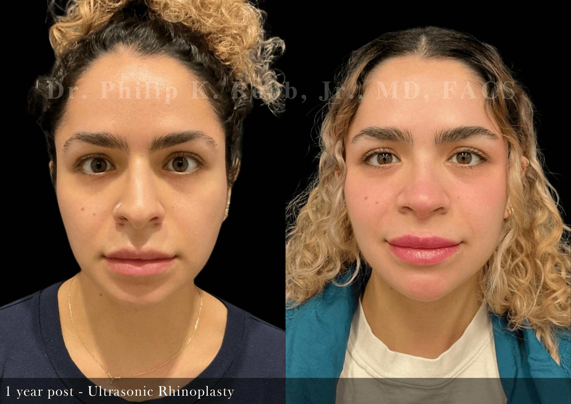 Ultrasonic Rhinoplasty Before & After Gallery - Patient 400435 - Image 3