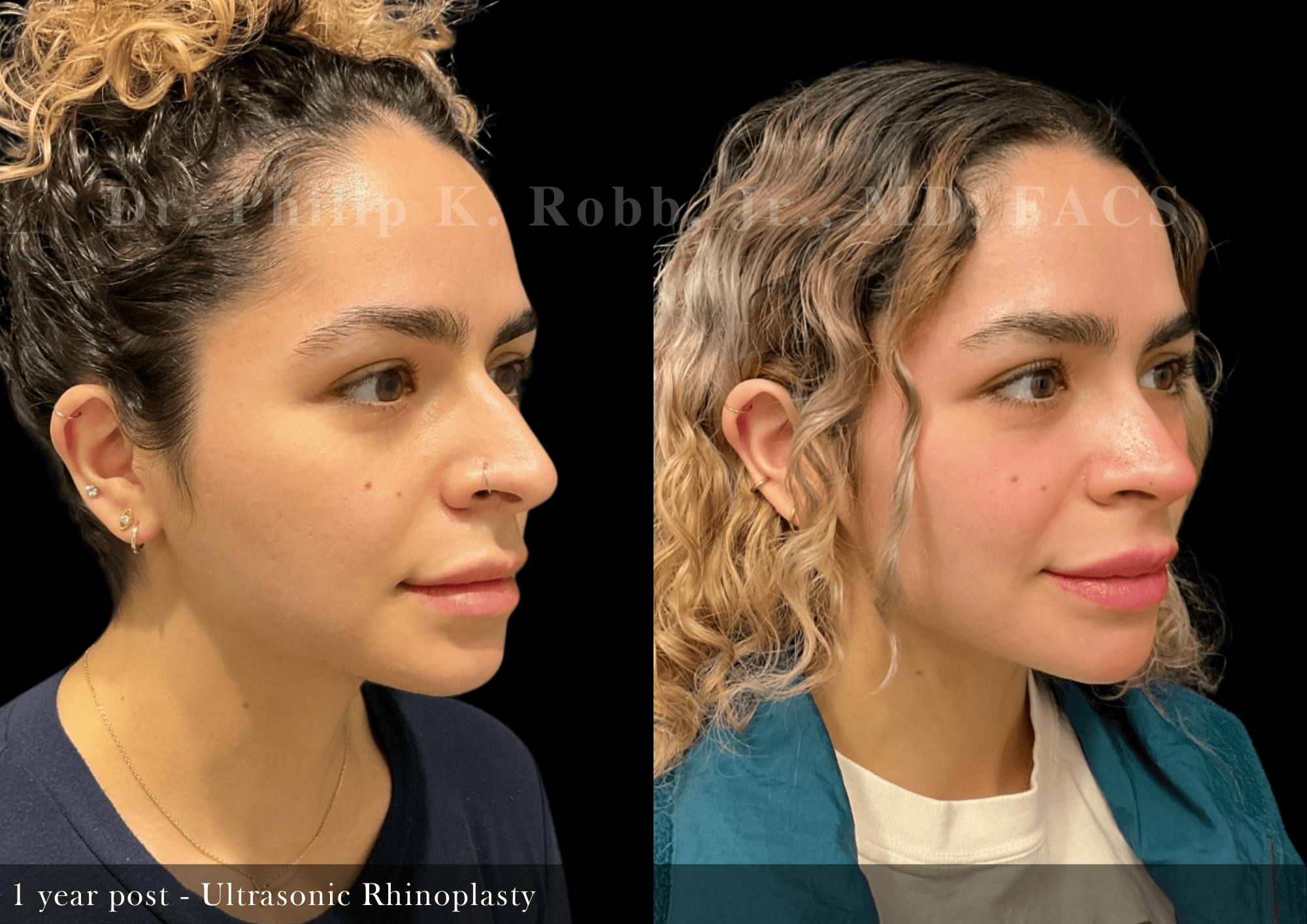Ultrasonic Rhinoplasty Before & After Gallery - Patient 400435 - Image 2