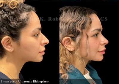 Ultrasonic Rhinoplasty Before & After Gallery - Patient 400435 - Image 1