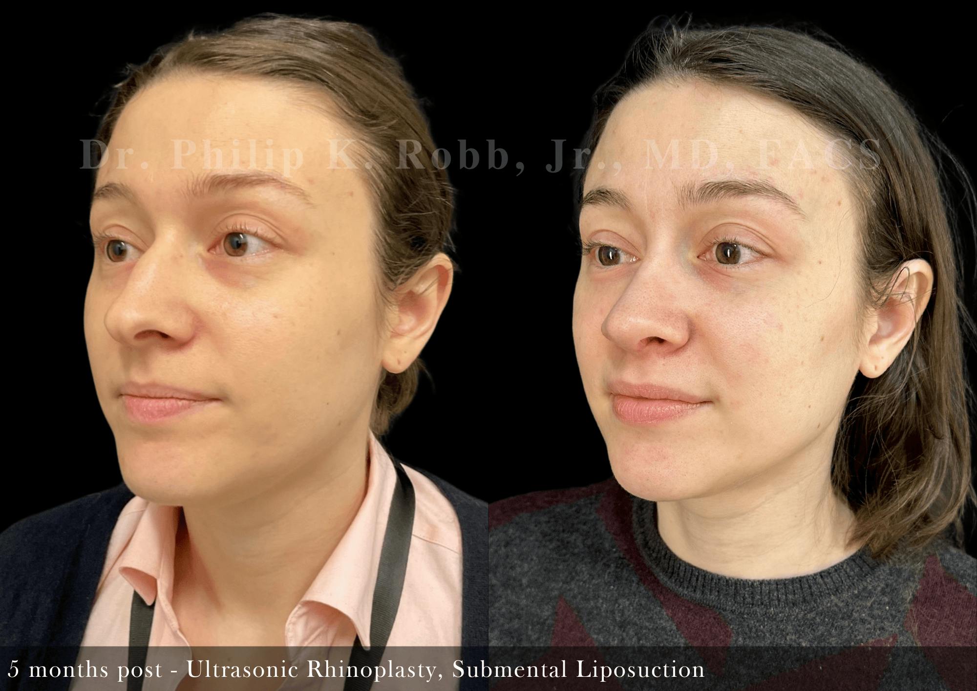 Submental Liposuction Before & After Gallery - Patient 120048 - Image 2
