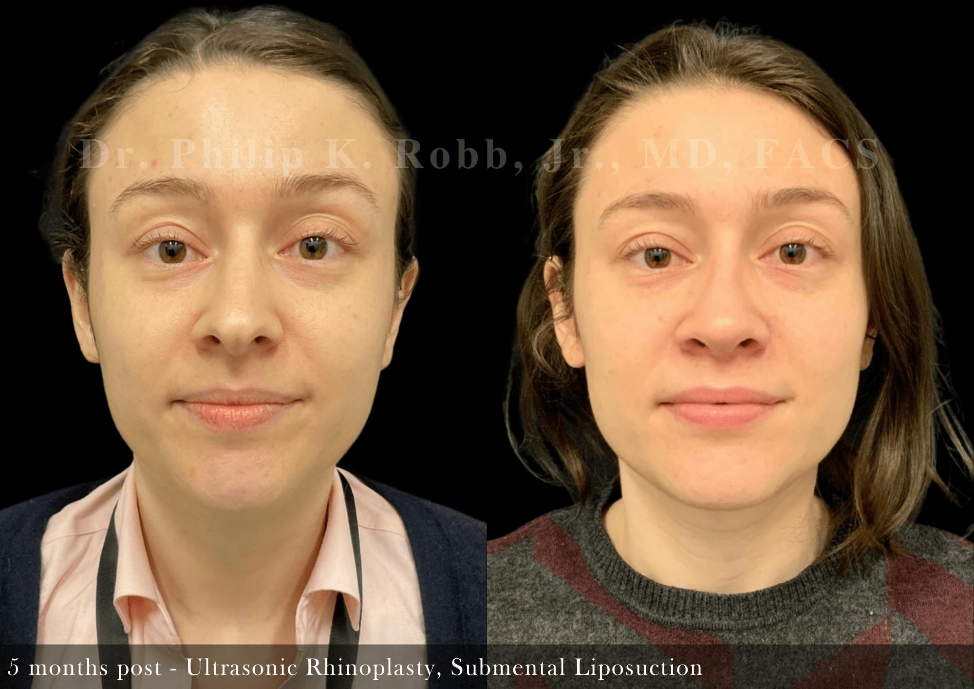Submental Liposuction Before & After Gallery - Patient 120048 - Image 1
