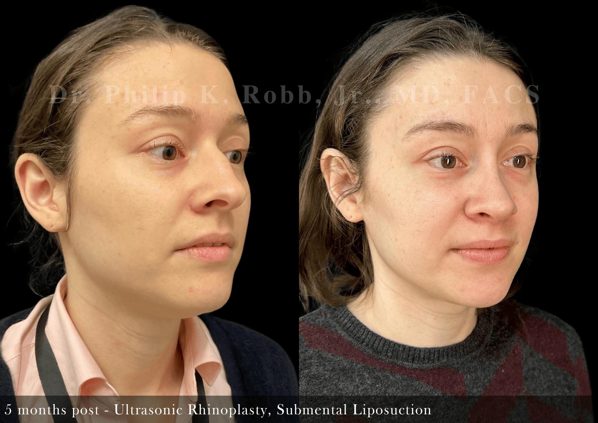 Submental Liposuction Before & After Gallery - Patient 120048 - Image 5