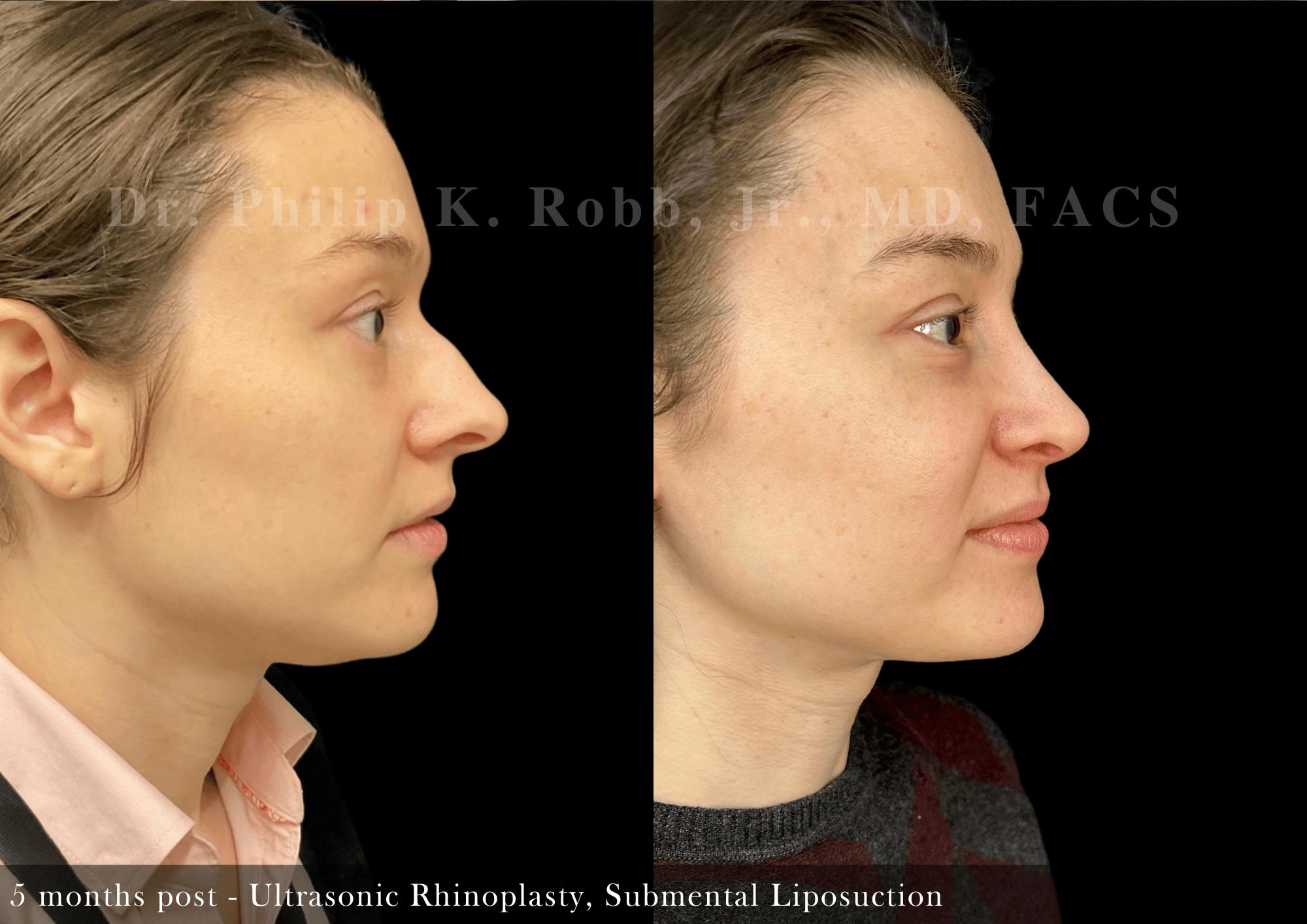 Submental Liposuction Before & After Gallery - Patient 120048 - Image 4