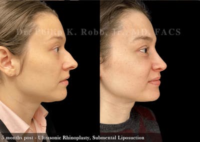 Ultrasonic Rhinoplasty Before & After Gallery - Patient 207617 - Image 1