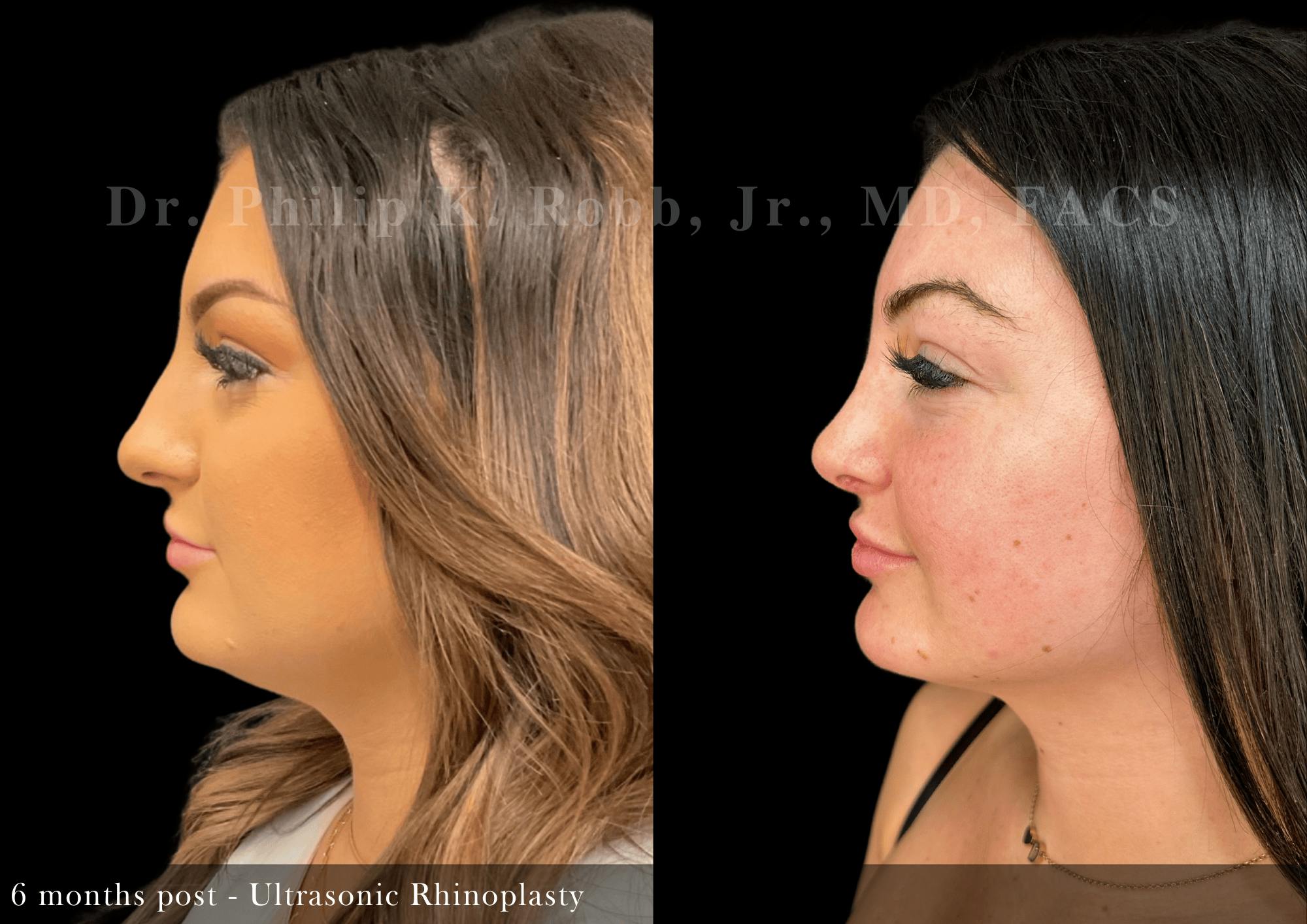 Ultrasonic Rhinoplasty Before & After Gallery - Patient 201524 - Image 5
