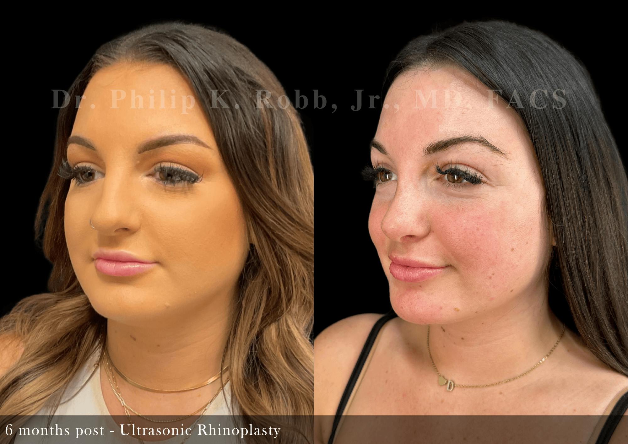 Ultrasonic Rhinoplasty Before & After Gallery - Patient 201524 - Image 4