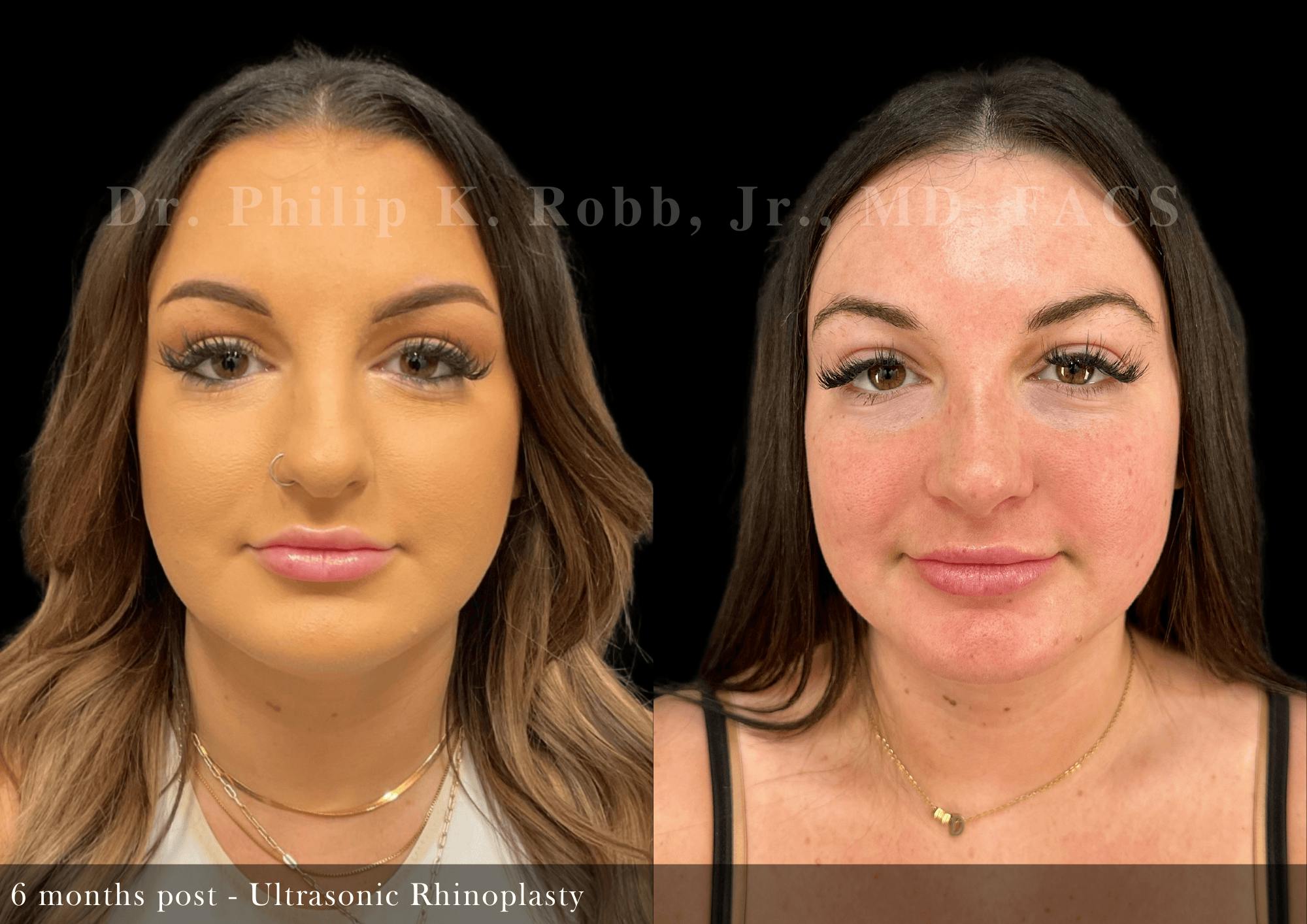 Ultrasonic Rhinoplasty Before & After Gallery - Patient 201524 - Image 3