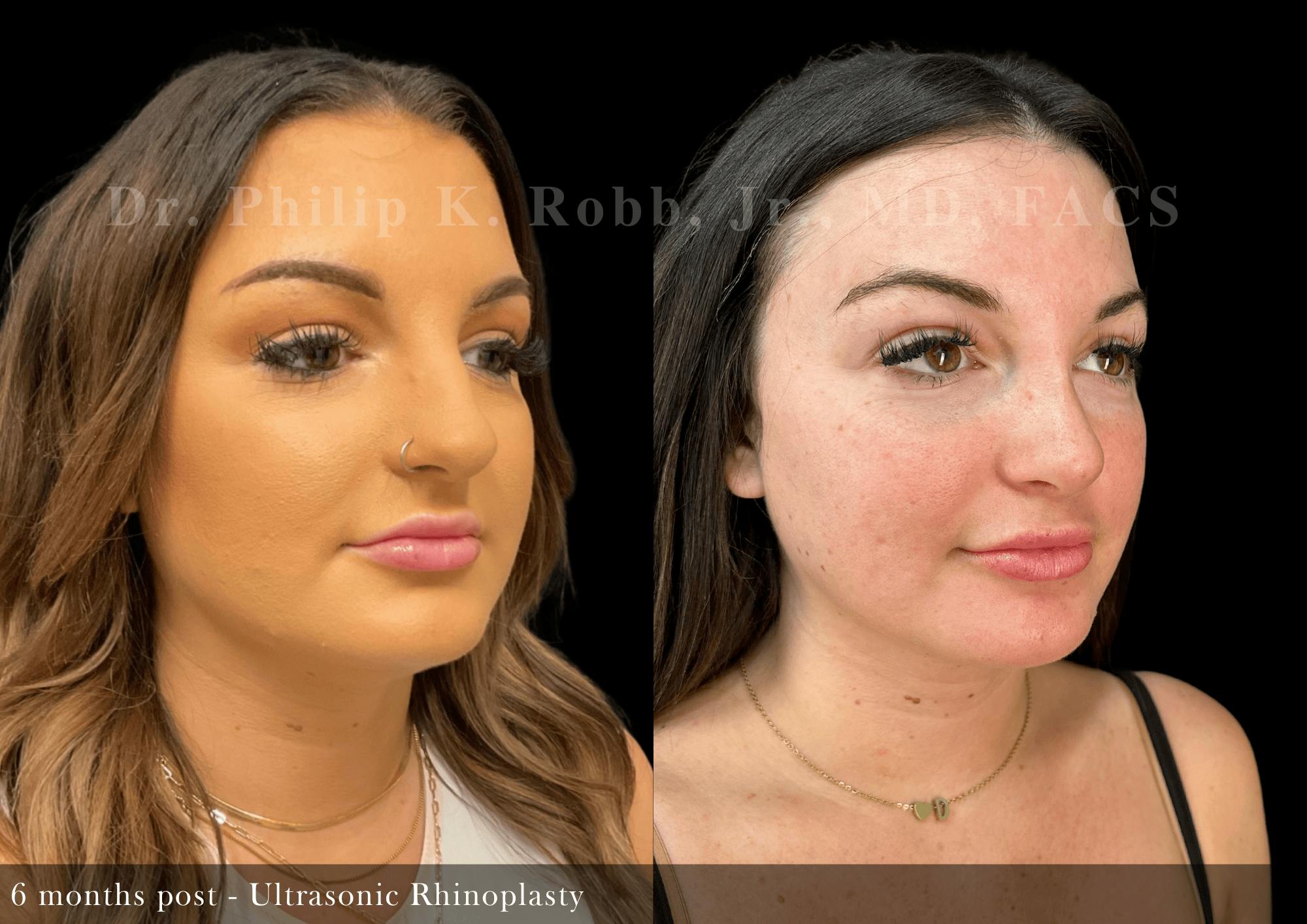 Ultrasonic Rhinoplasty Before & After Gallery - Patient 201524 - Image 2