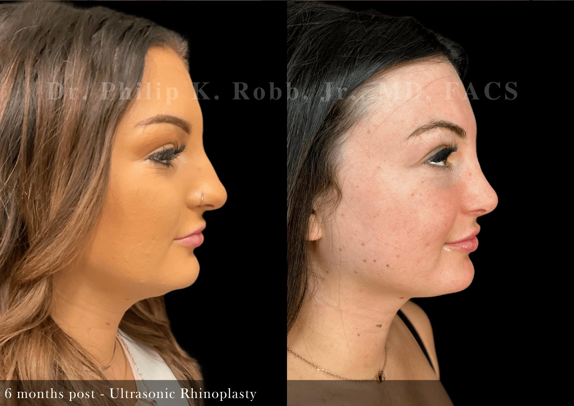 Ultrasonic Rhinoplasty Before & After Gallery - Patient 201524 - Image 1