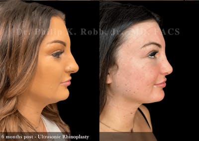 Ultrasonic Rhinoplasty Before & After Gallery - Patient 201524 - Image 1