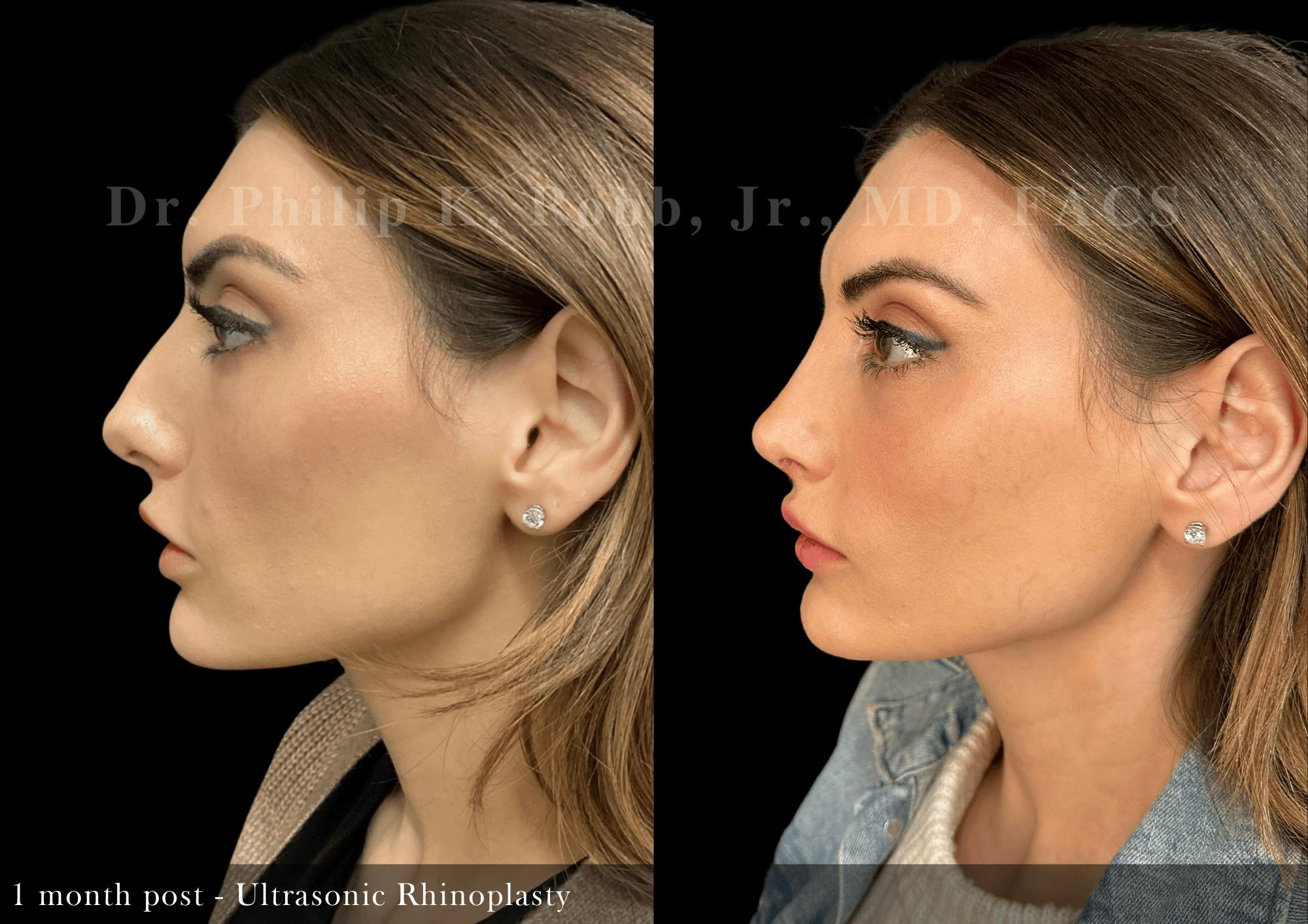 Ultrasonic Rhinoplasty Before & After Gallery - Patient 484471 - Image 5