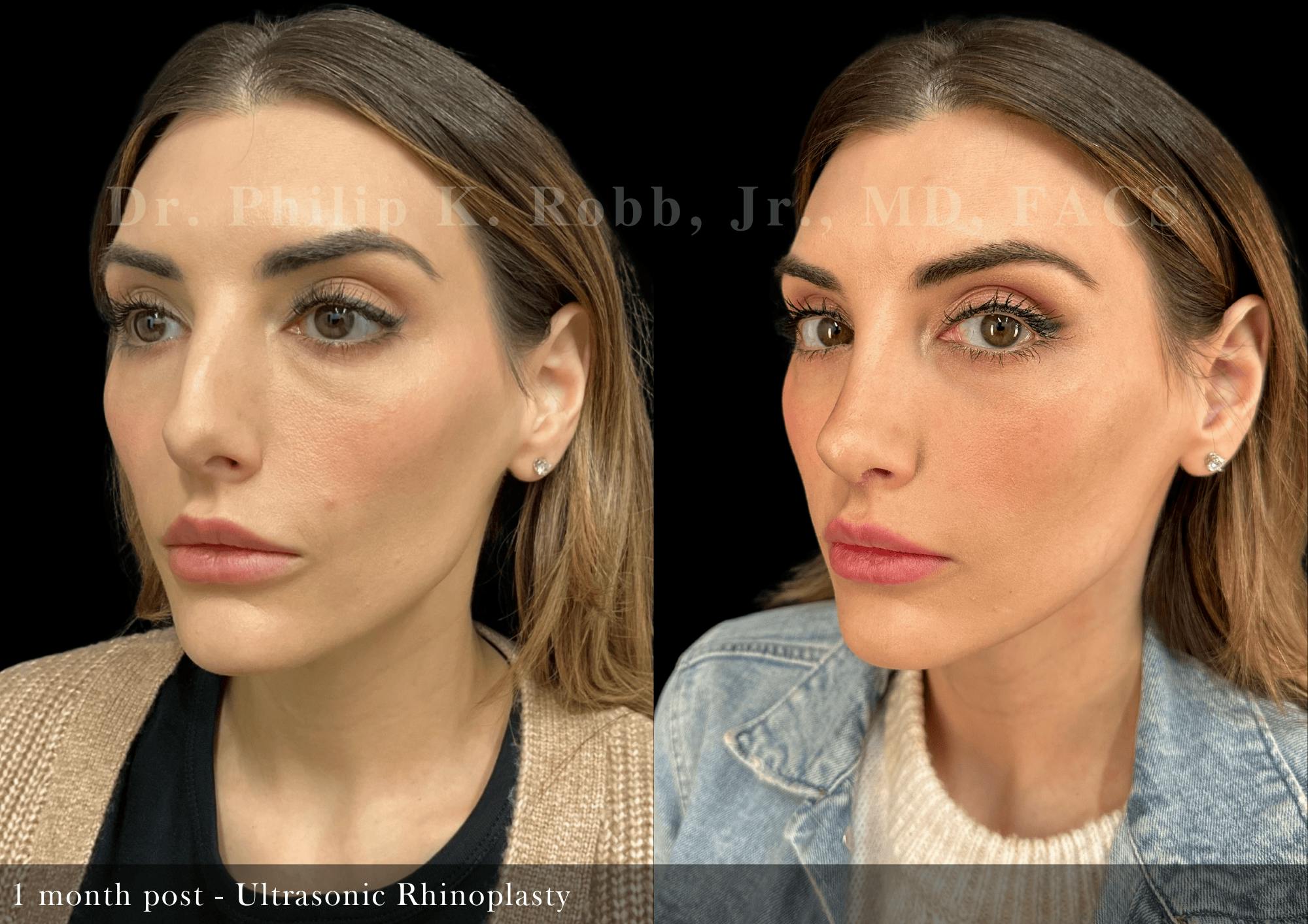 Ultrasonic Rhinoplasty Before & After Gallery - Patient 484471 - Image 4