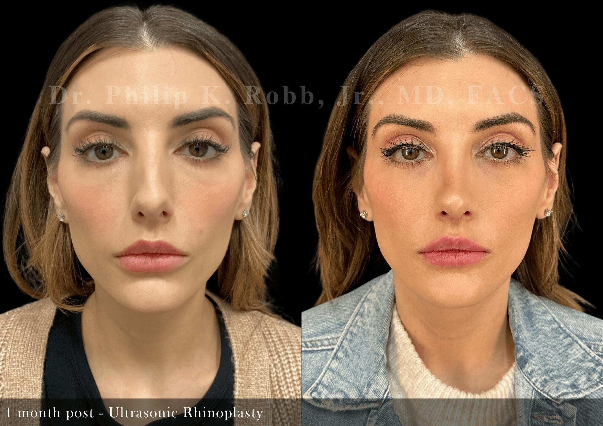 Ultrasonic Rhinoplasty Before & After Gallery - Patient 484471 - Image 3