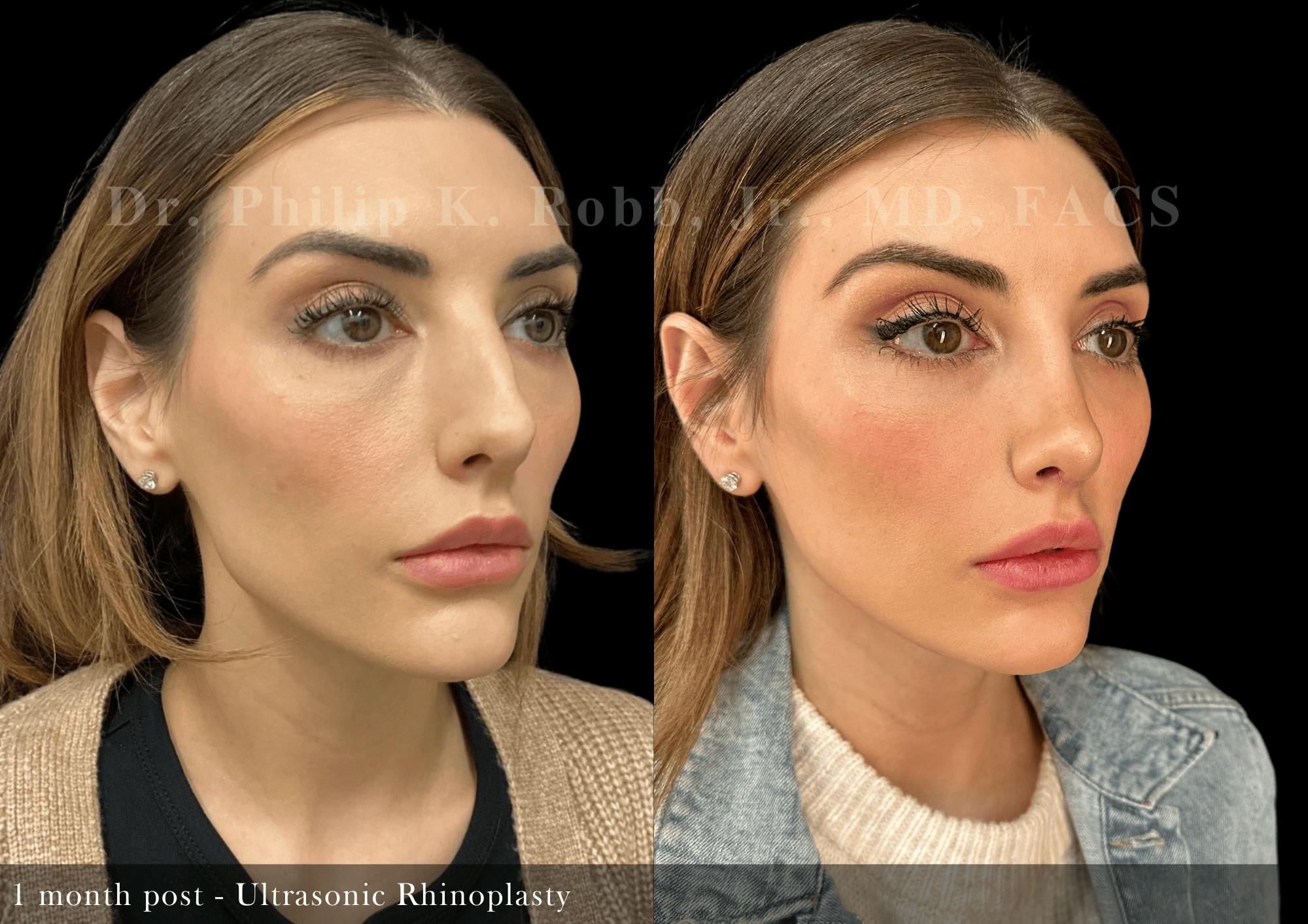 Ultrasonic Rhinoplasty Before & After Gallery - Patient 484471 - Image 2