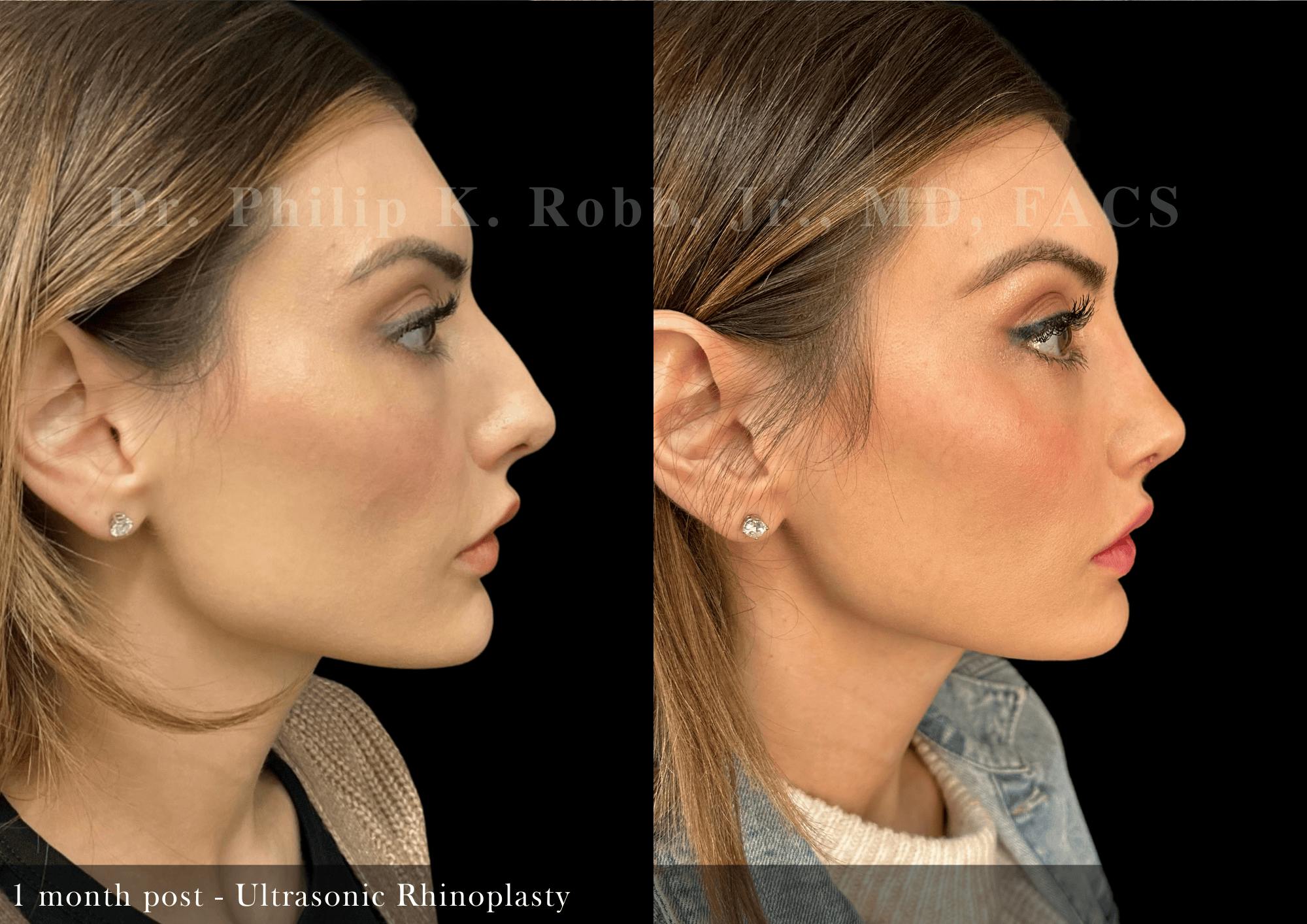 Ultrasonic Rhinoplasty Before & After Gallery - Patient 484471 - Image 1
