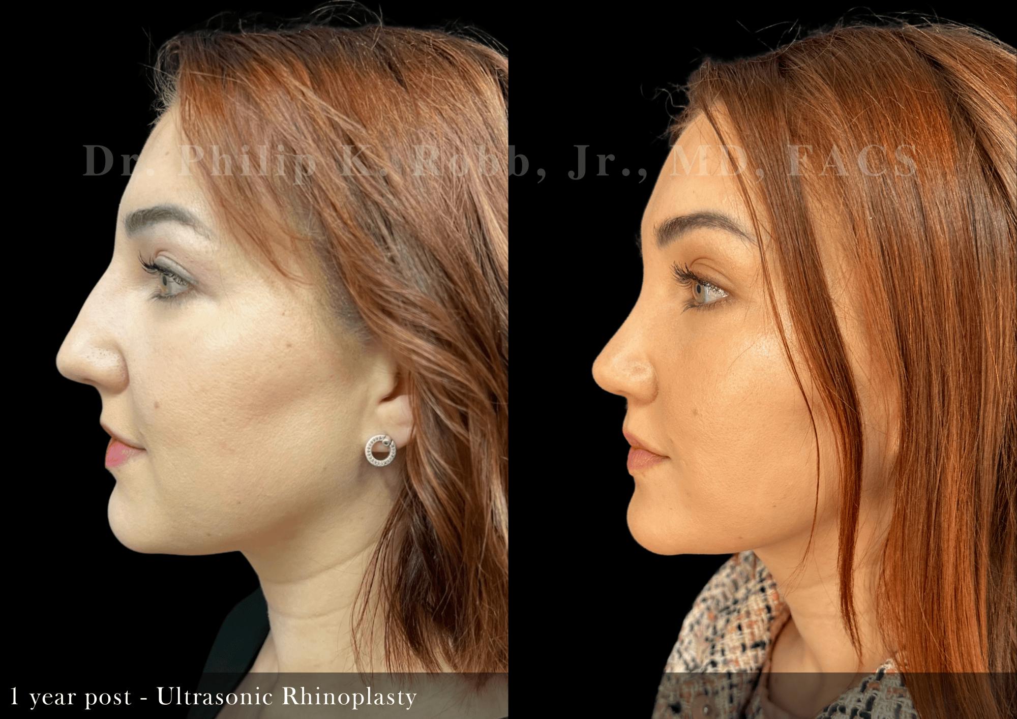 Ultrasonic Rhinoplasty Before & After Gallery - Patient 146676 - Image 5